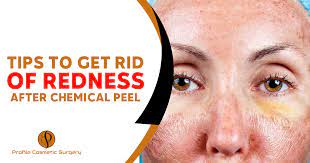 get rid of redness after chemical l