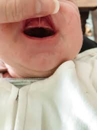lip tie affecting tfeeding