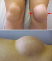 Their work involves multiple sources of acute and chronic knee trauma including kneeling, pressure from sharp objects, and use of a device called a knee kicker to stretch wall to wall carpet. Prepatellar Kneecap Bursitis Orthoinfo Aaos