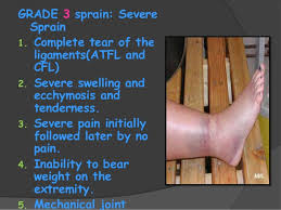 A grade 3 mcl injury is the most severe type of ligament injury. Ankle Sprains