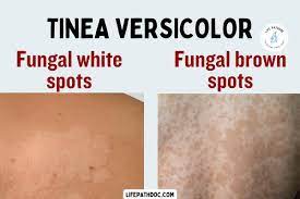 tinea versicolor brown spots or white