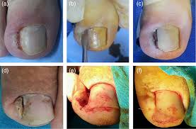 the treatment of ingrown nail chemical