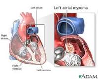 Image result for icd 10 code for left atrial myxoma