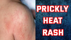 heat rash home remes how to get