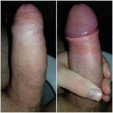 Beschnittener penis bilder