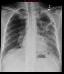 La fibrosis pulmonar es una enfermedad crónica en la que el tejido de los pulmones cicatriza y se vuelve grueso y duro, lo que produce dificultades respiratorias y puede. Etiologia De La Fibrosis Pulmonar Encontrando Las Causas