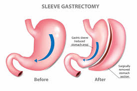 bariatric surgery carbondale il