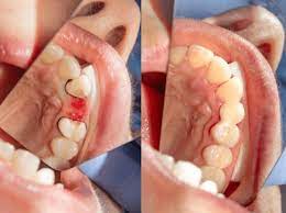 do dental bridges hurt dentist in