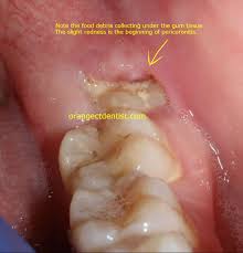 pericoronitis wisdom teeth dentist