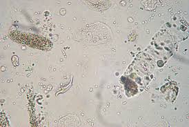 Dengue Hemorrhagic Fever  Case Study               Urinalysis