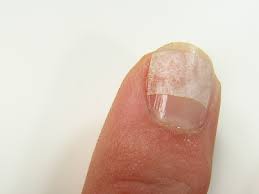 bandage a ed nail
