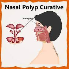 best treatment for nasal polyps nasal