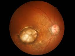 what are the symptoms of macular holes