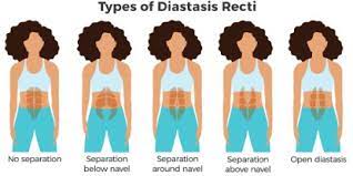 So this is how you do it. Diastasis Recti In Pregnancy Ab Separation Causes Treatment