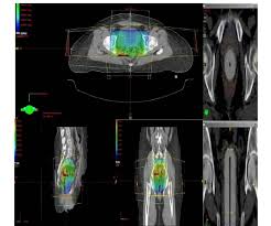 a external beam radiation therapy