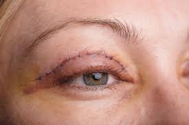 your guide to eyelid surgery recovery