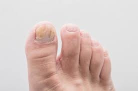 foot to toenail fungus