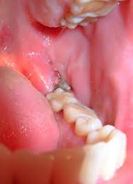 gum infection what is pericoronitis