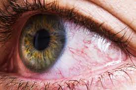 eye redness causes and treatments