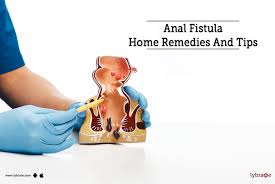 fistula home remes and tips