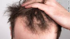 one male hair loss treatment works