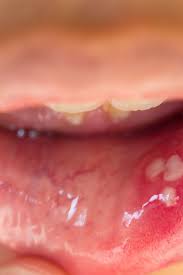 hpv in the mouth symptoms causes and