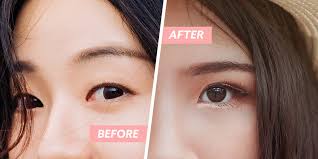 double eyelid surgery in singapore