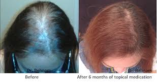 topical finasteride for hair growth