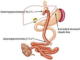 complications of bariatric surgery