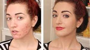 cover up a bad breakout and acne scars