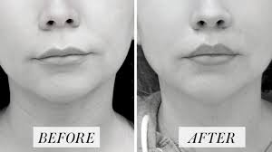 what is a lip lift doctors explain the