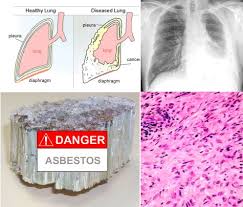 Asbestos is the name of a group of minerals with long, thin fibers. Detecting Mesothelioma Asbestos Related Cancer Medchrome
