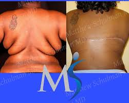 top surgery after weight loss new york