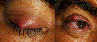 stye what is it and how is it treated