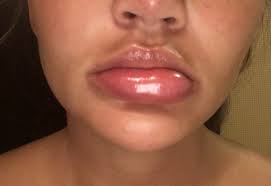 chrissy teigen blames swollen lips on