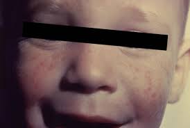 When your baby's meningitis develops into septicaemia, a rash may appear under the skin as a cluster of tiny spots. Meningitis Rash Pictures Symptoms And Similar Rashes