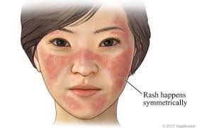 lupus rash video image