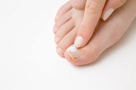 do you have toenail fungus hubert lee
