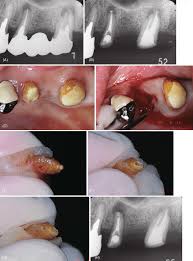 chronic apical periodonis