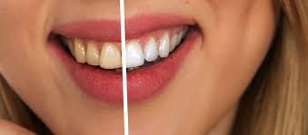 bad teeth whitening side effects