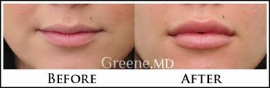lip augmentation and enhancement expert