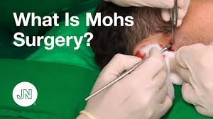 mohs surgery frequently asked questions