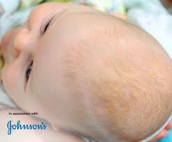 Cradle cap, medically called infantile seborrheic dermatitis, is one of the common skin problems among babies. Cradle Cap In Babies Causes Symptoms And Treatments Baby Skincare Emma S Diary