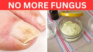 the secret to banishing toenail fungus