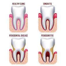 Periodontics Calgary Ne Madigan Dental
