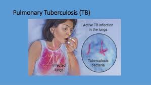 Tb is spread from person to person through the air. Tuberculosis Tb