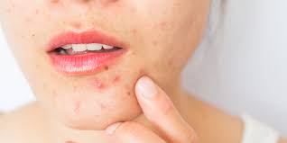 cystic acne dermatologists explain