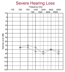 What Is An Audiogram Understanding Hearing Test Results