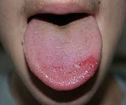 burning mouth syndrome symptoms
