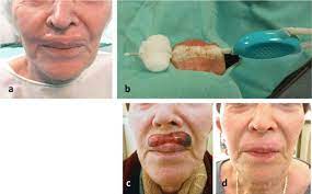treatment of upper lip keloid following